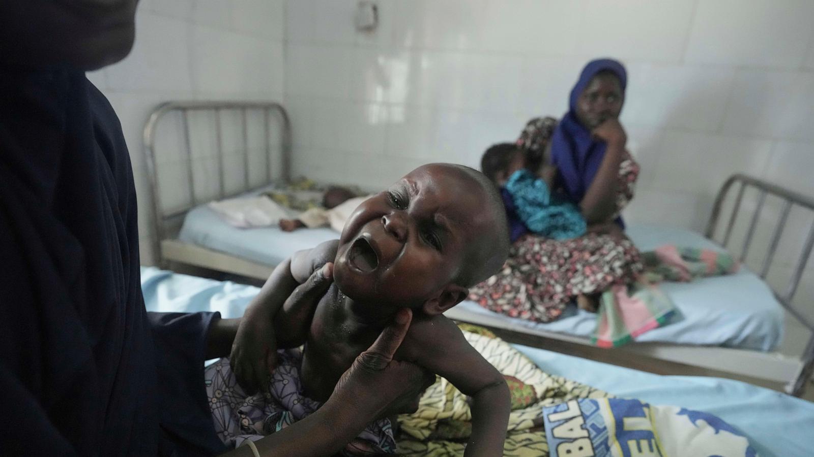 Children die as USAID aid cuts snap a lifeline for the world’s most malnourished