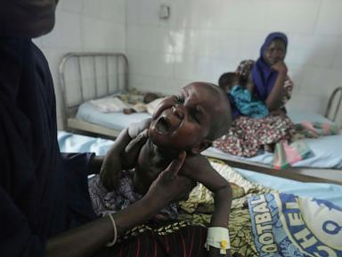 Children die as USAID aid cuts snap a lifeline for the world's most malnourished