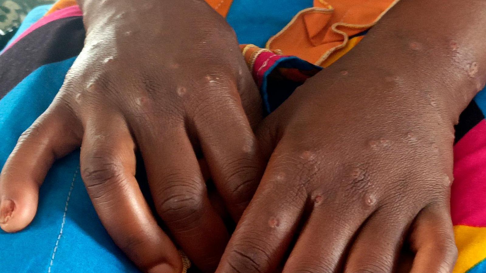 US aid cuts are hurting Africa’s ability to respond to disease outbreaks, health chief says