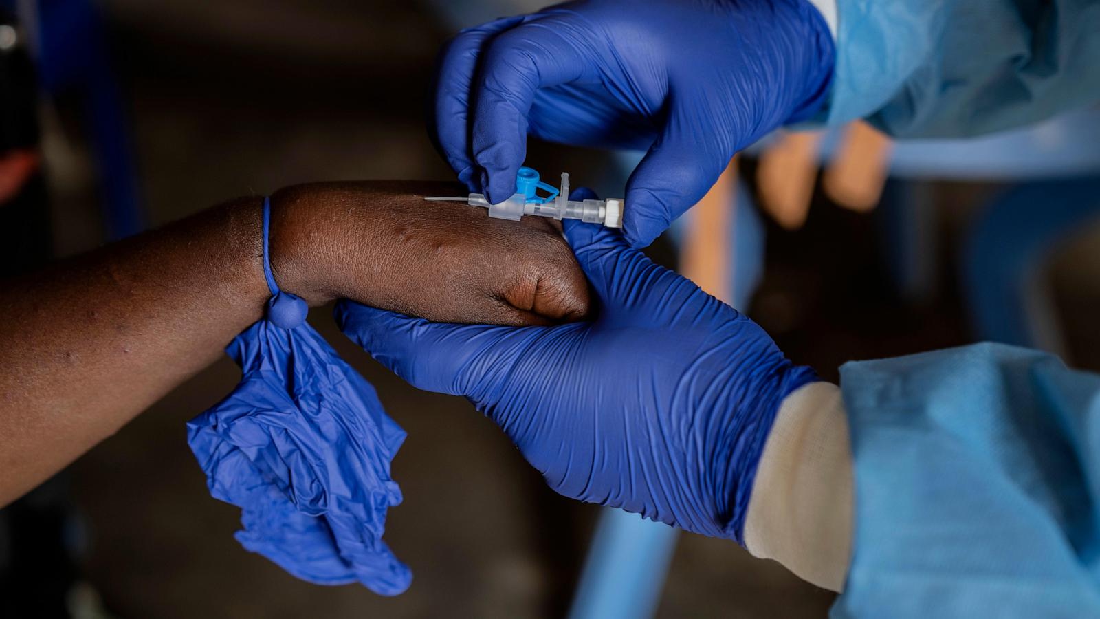 The UN authorizes the 1st mpox vaccine for children in an attempt to control the outbreak in Congo