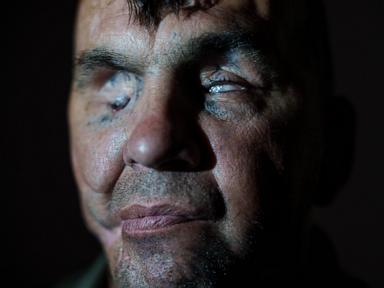 A Ukrainian soldier lost his sight in war. Now he hopes to see his children again