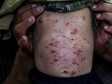 Lice, scabies, rashes plague children as skin disease runs rampant in Gaza's camps