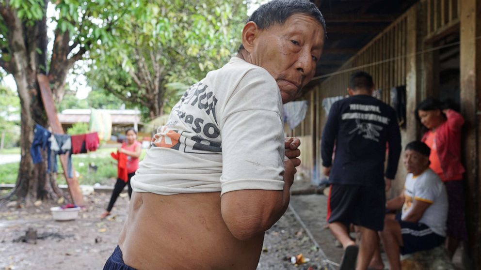 PHOTO: A Nahua elder displays a scar from an arrow wound. The Nahua live in a protected territorial reserve home to several bands of isolated tribes.