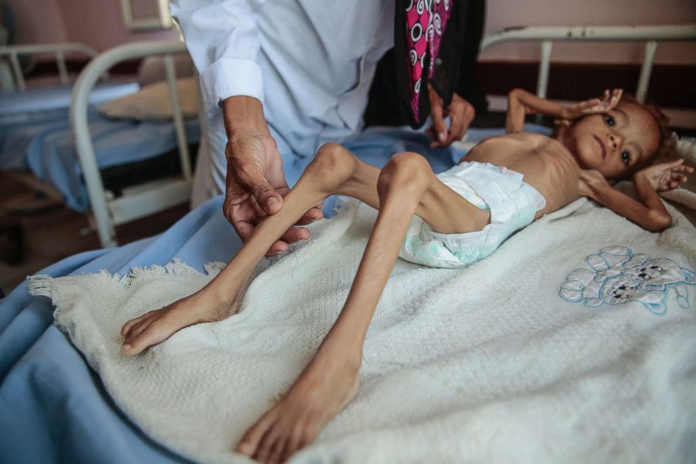 PHOTO: In this Oct. 1, 2018, photo, a severely malnourished boy rests on a hospital bed at the Aslam Health Center, Hajjah, Yemen. 