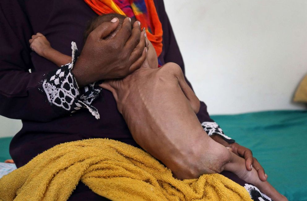 PHOTO: A woman holds a child suffering from malnutrition at a treatment center in a hospital in Taez, Yemen, Nov. 21, 2018.