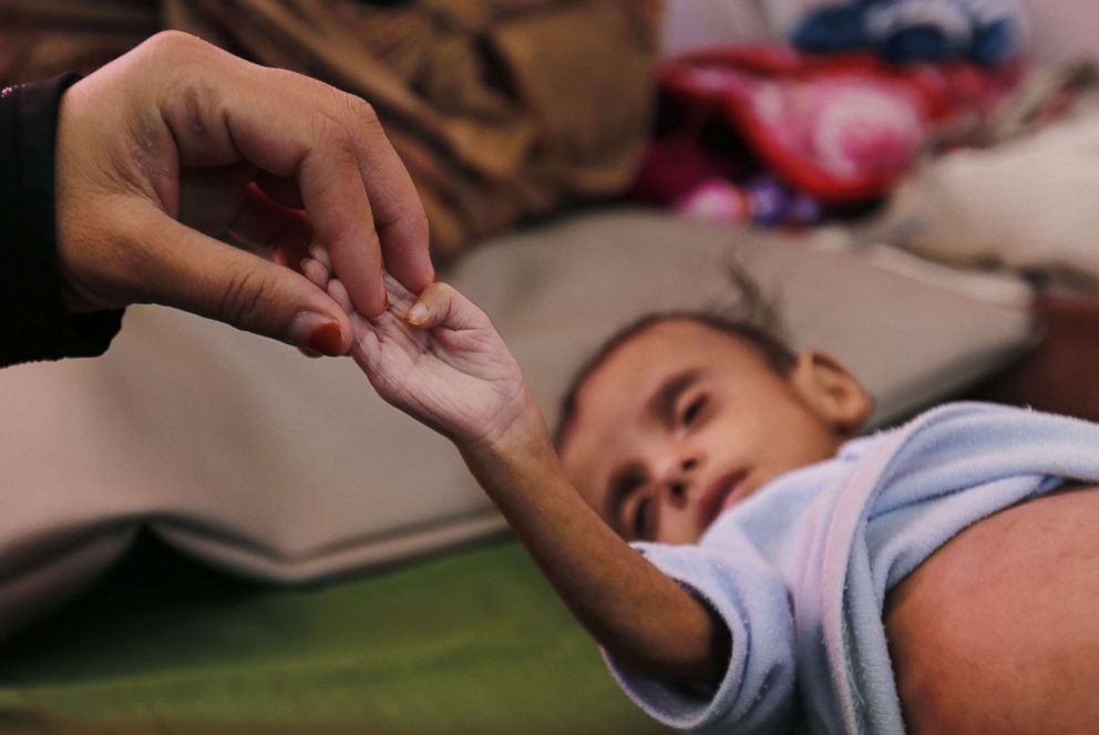 PHOTO: A woman holds a hand of her malnourished child as he receives medical attention at a malnutrition treatment center in Sanaa, Yemen, Nov. 16, 2018.