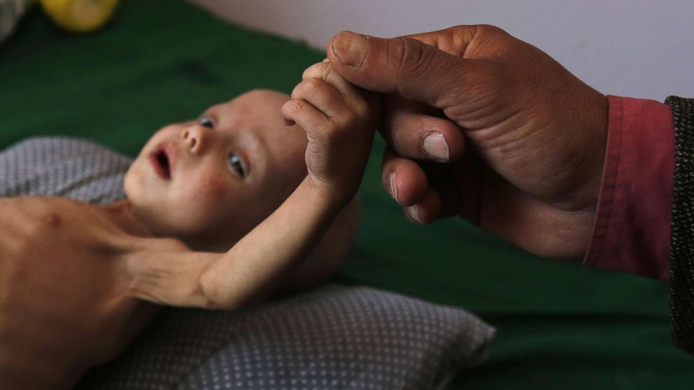 A malnourished Yemeni child receives treatment amid worsening malnutrition in the emergency ward of a hospital in Sana'a, Yemen, Nov. 15, 2017. 