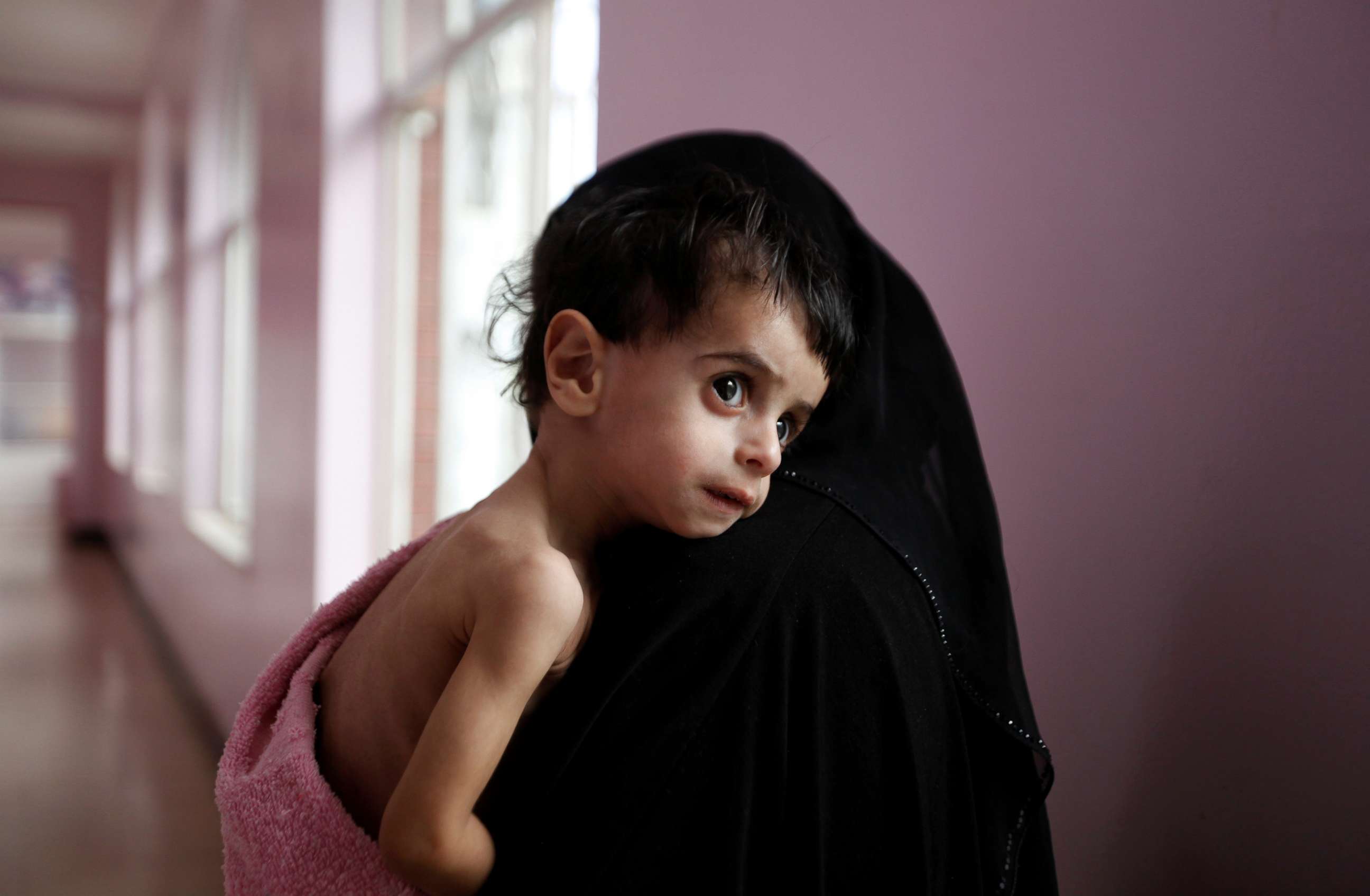 PHOTO: A woman holds her malnourished boy after he was weighed at a hospital malnutrition intensive care unit in Sanaa, Yemen, Sept. 27, 2016. 