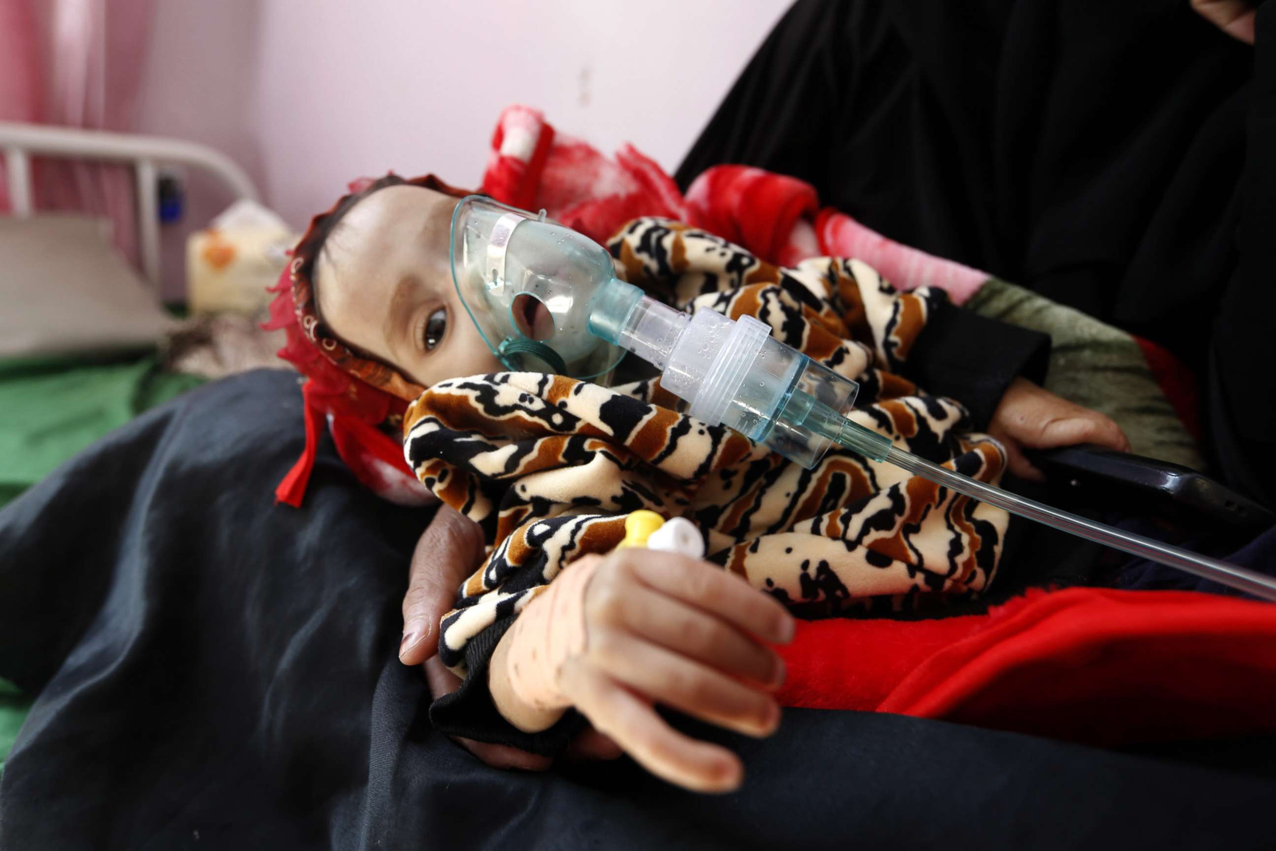 PHOTO: A malnourished Yemeni child receives treatment at a hospital in the capital Sanaa, Nov. 22, 2017. The United Nations has warned that war-wracked Yemen faces a mass famine unless aid deliveries are allowed to enter the impoverished country. 