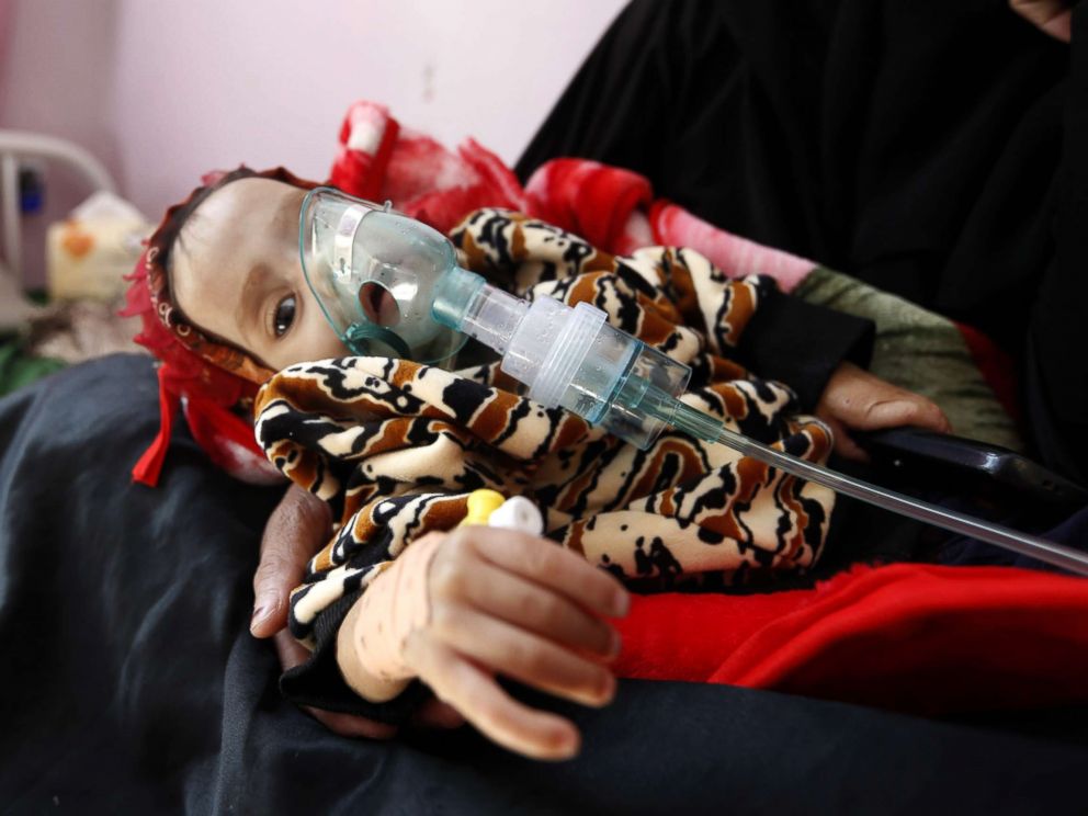 PHOTO: A malnourished Yemeni child receives treatment at a hospital in the capital Sanaa, Nov. 22, 2017. The United Nations has warned that war-wracked Yemen faces a mass famine unless aid deliveries are allowed to enter the impoverished country.