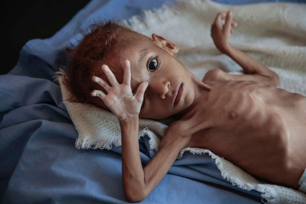 PHOTO: A severely malnourished boy rests on a hospital bed at the Aslam Health Center, Hajjah, Yemen, Oct. 1, 2018. An estimated 85,000 children under age 5 may have died of hunger and disease since the outbreak of the civil war.