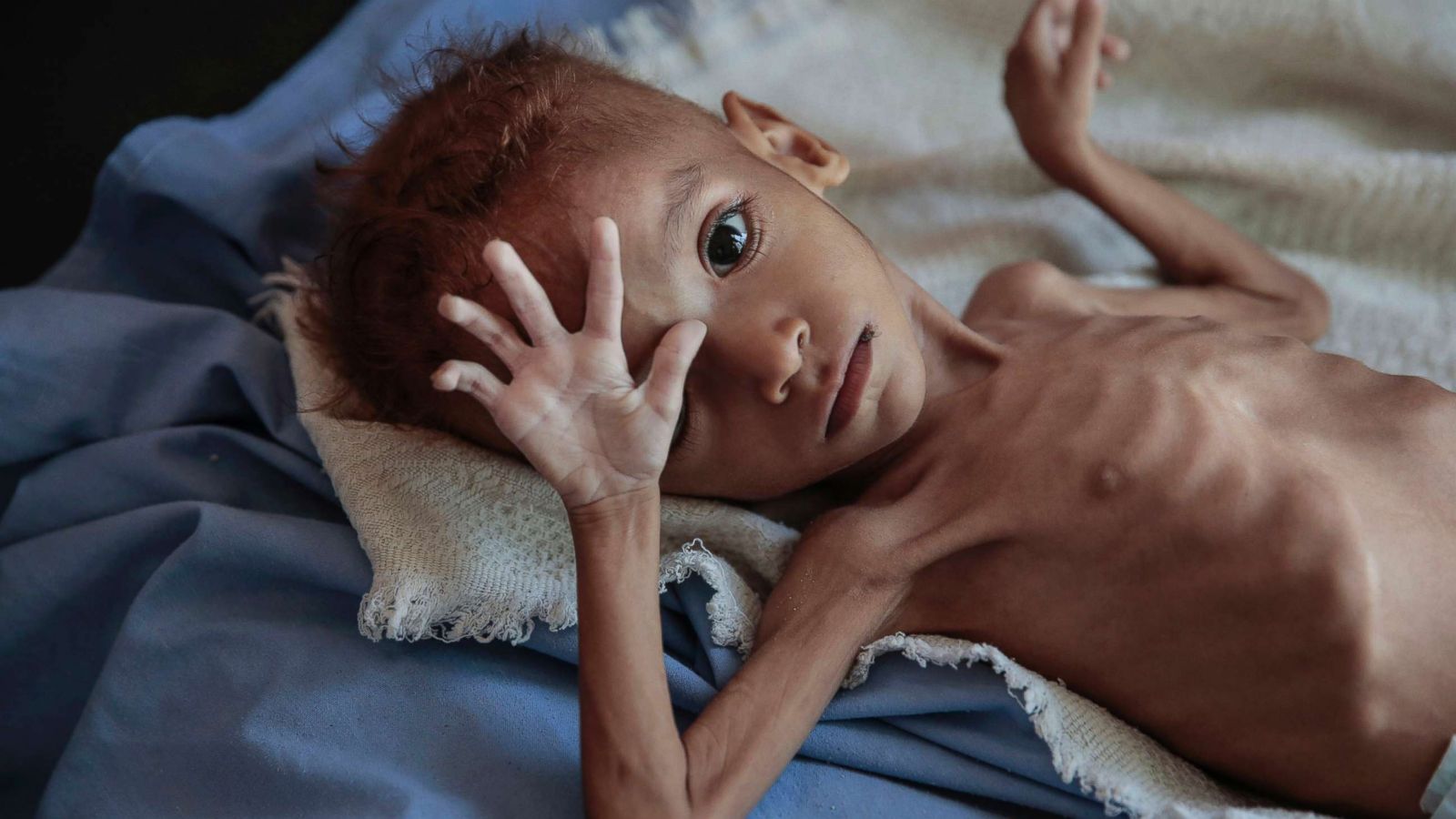 85,000 children in Yemen have starved to death: Save the Children report - ABC News