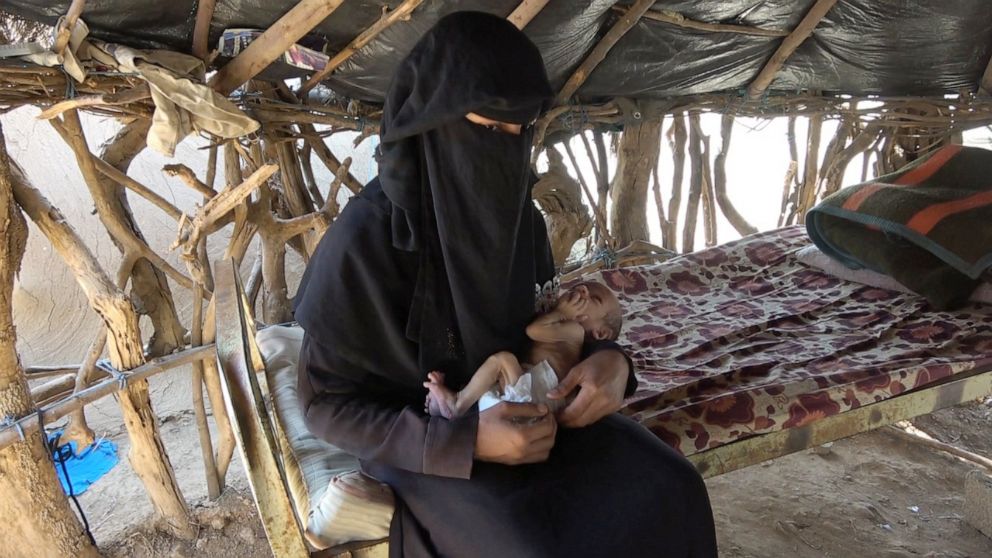PHOTO: According to the WFP, 2 million children need treatment in Yemen for severe malnutrition.
