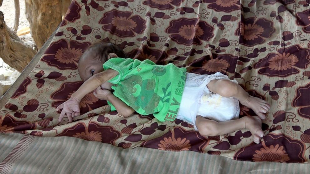 PHOTO: At four months old, Hussain Al-Kholani weighs less than a third of the average American child of the same age.