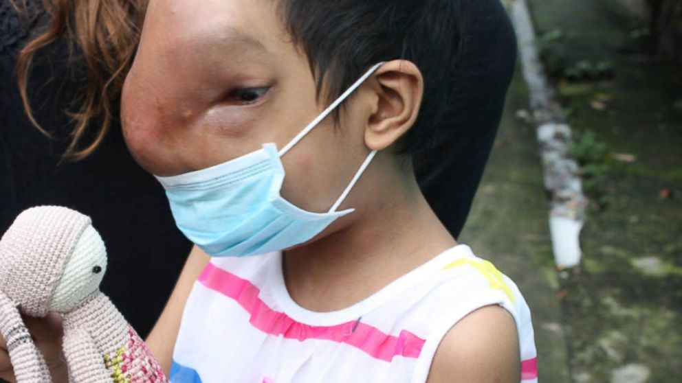 The cancer has led to severe facial abnormalities but has not dampened the girl's spirit.