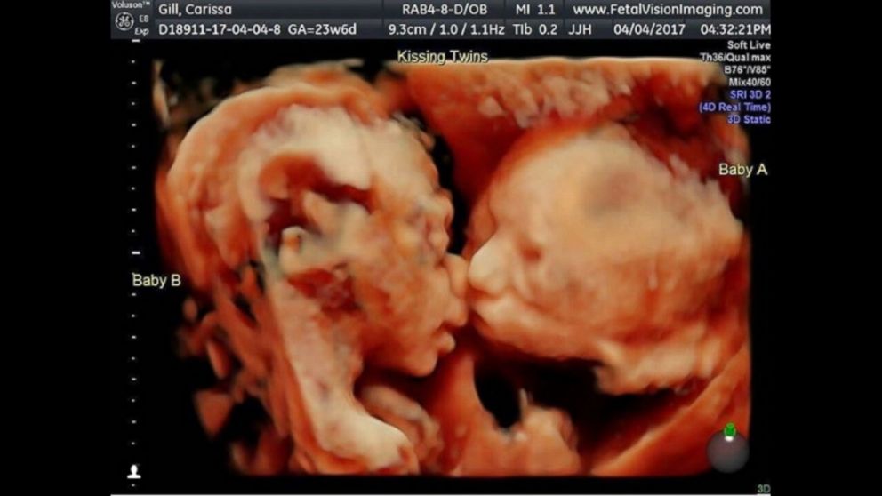 Sonogram shows twin sisters 'kissing' inside mother's womb - ABC News