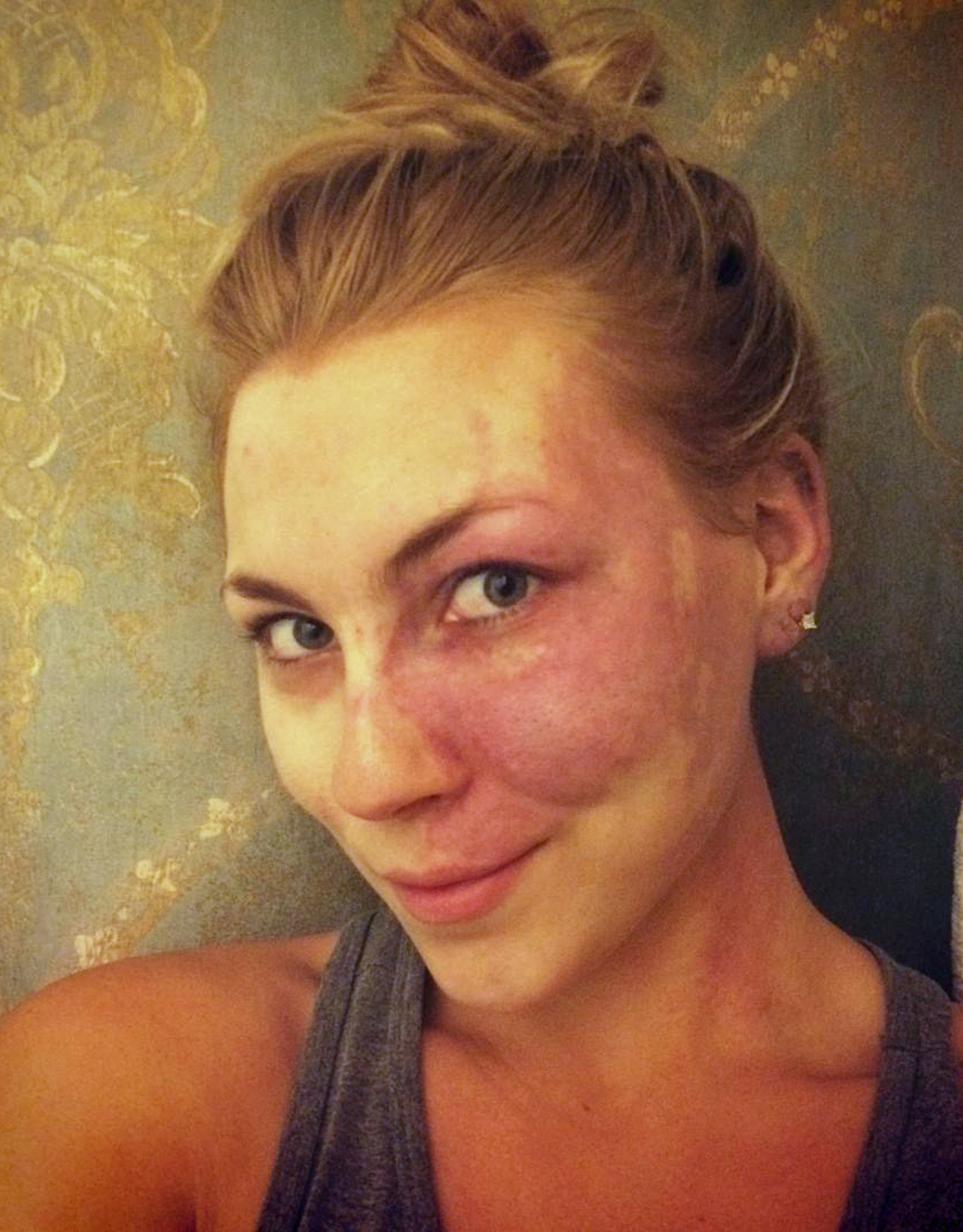 PHOTO: Paige Billiot, 23, an actress and filmmaker from Los Angeles, was born with a dark red mark covering her left cheek known as a port-wine stain. 