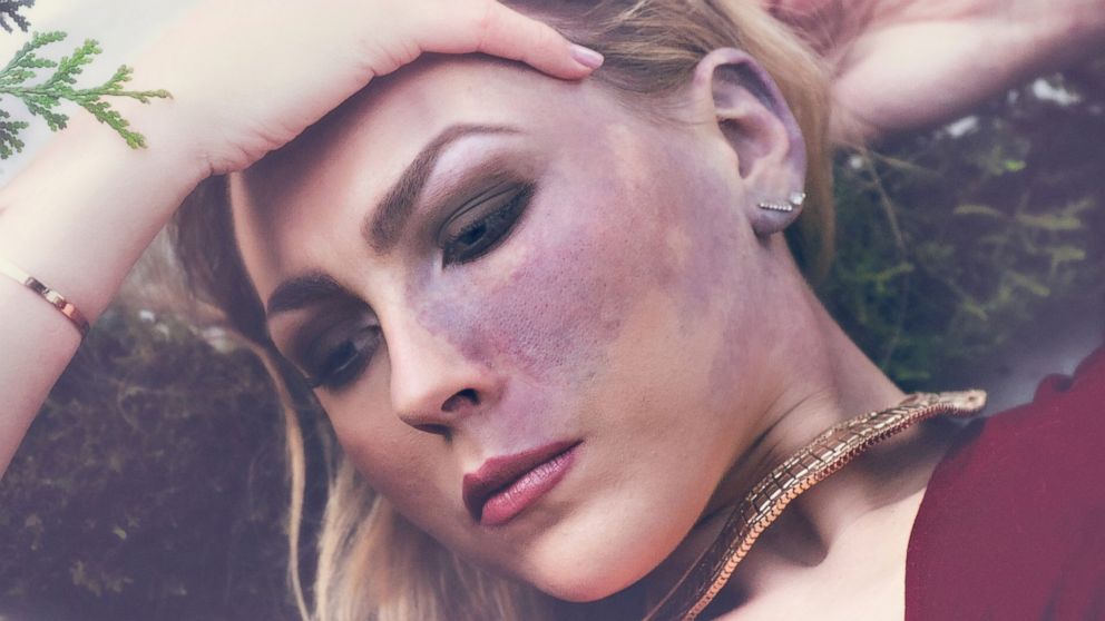 Paige Billiot, 23, an actress and filmmaker from Los Angeles, was born with a dark red mark covering her left cheek known as a port-wine stain. The young woman collaborated with a number of photographers to create an artistic photos series to bring positive attention to skin discolorations.