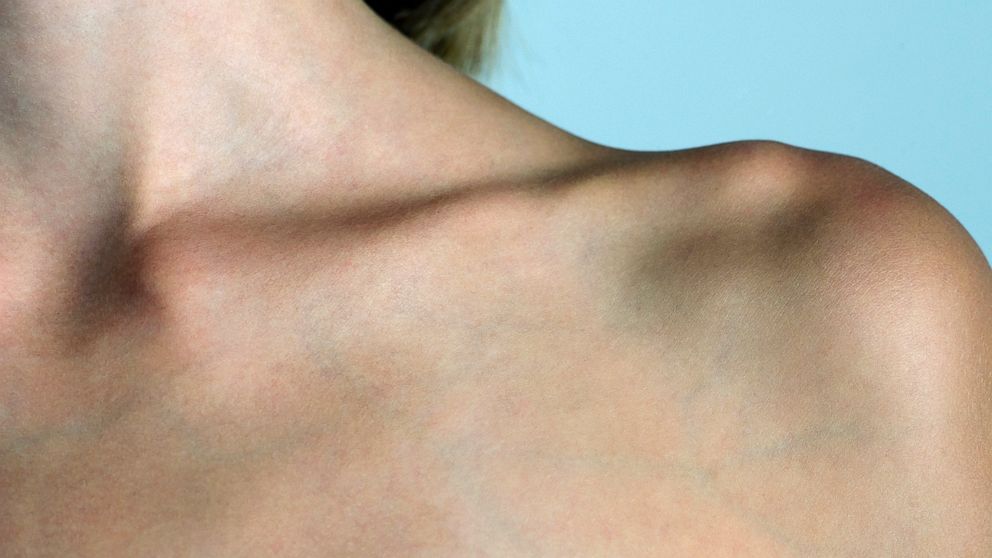  Collarbone Challenge Latest On Social Media To Raise Concern ABC News