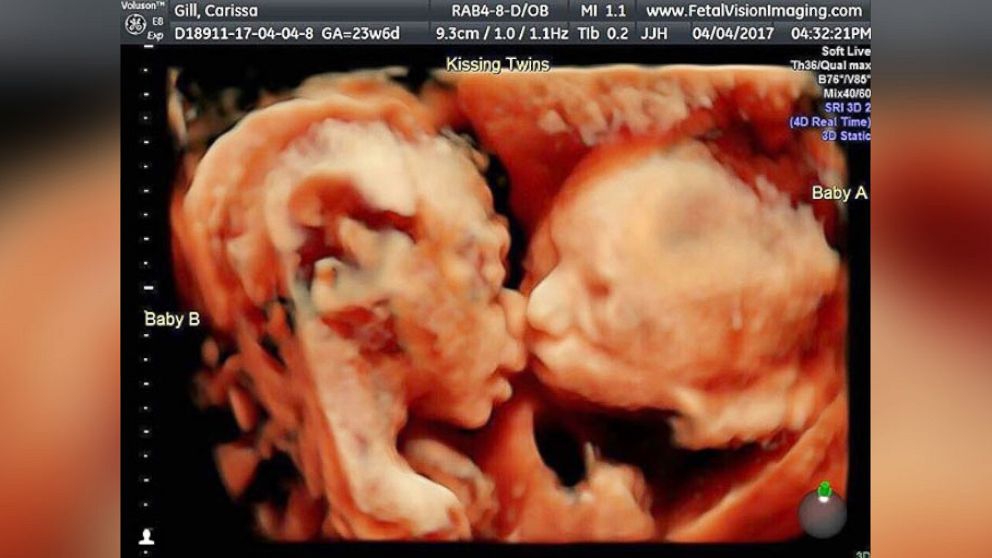 Pregnant mom's ultrasound reveals twin babies 'kissing' inside womb