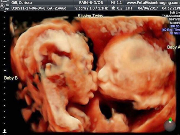 Pregnant mom's ultrasound reveals twin babies 'kissing ...