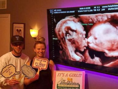 Pregnant Mom S Ultrasound Reveals Twin Babies Kissing Inside Womb Abc News