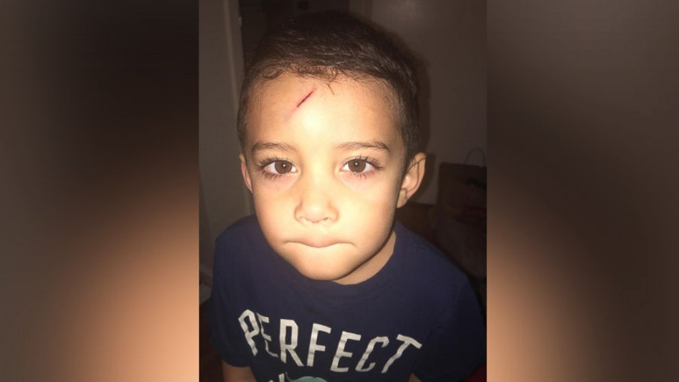 PHOTO: Ayden Benesh-Lastrella was embarrassed to leave the house after getting this scar on his forehead.