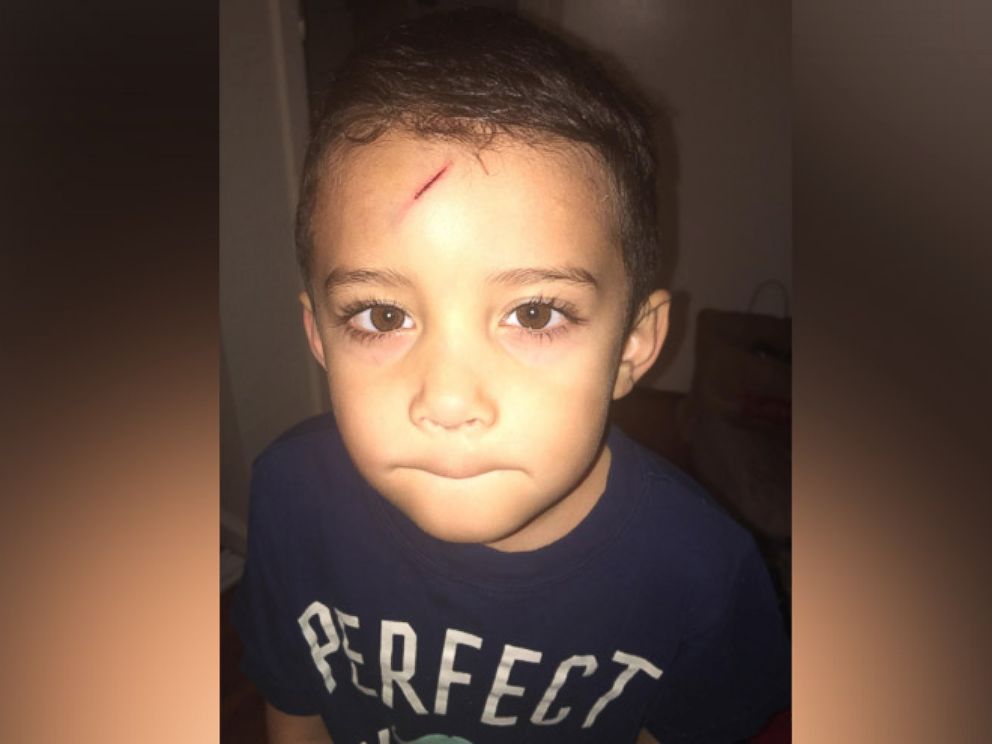 PHOTO: Ayden Benesh-Lastrella was embarrassed to leave the house after getting this scar on his forehead.