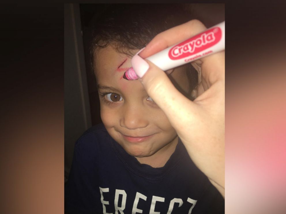 PHOTO: Ayden Benesh-Lastrella's mother Brittaney cheered her son up by turning his scar into Harry Potter's scar shaped like a lightning bolt.