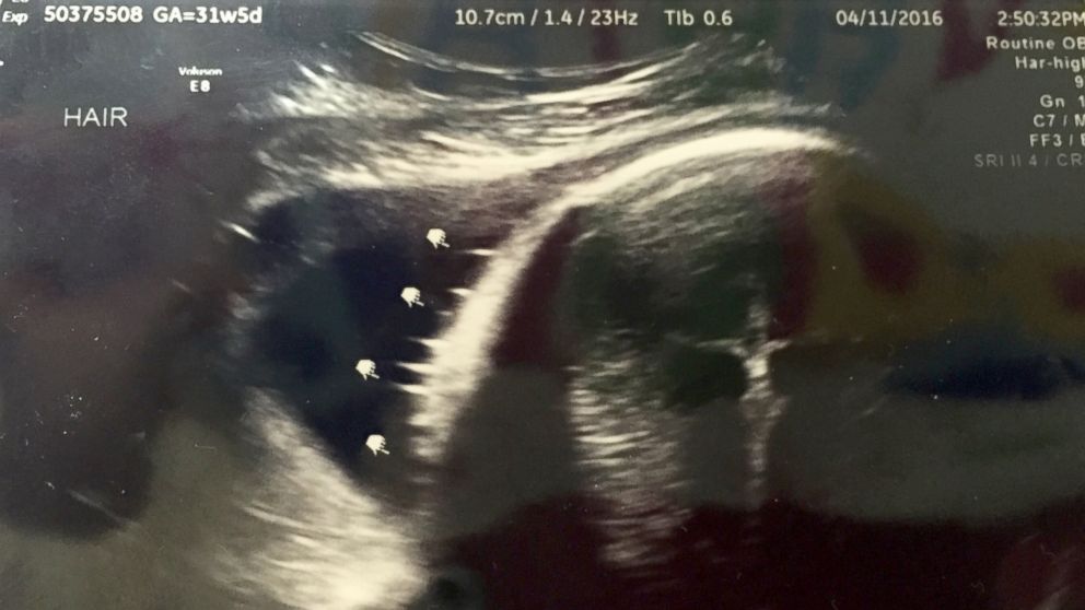 Aley Meyer's sonogram, taken on April 11, shows what appears to be a crucifix. 