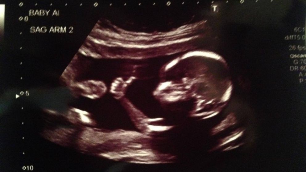 Baby flashes thumbs up in coolest ultrasound ever.