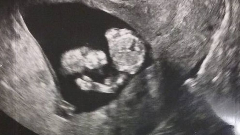 Mehgan Merriott and Robert Cooper of Columbus, Georgia said her baby appeared to be saluting to her and the baby's marine dad in a sonogram photo dated September 12.