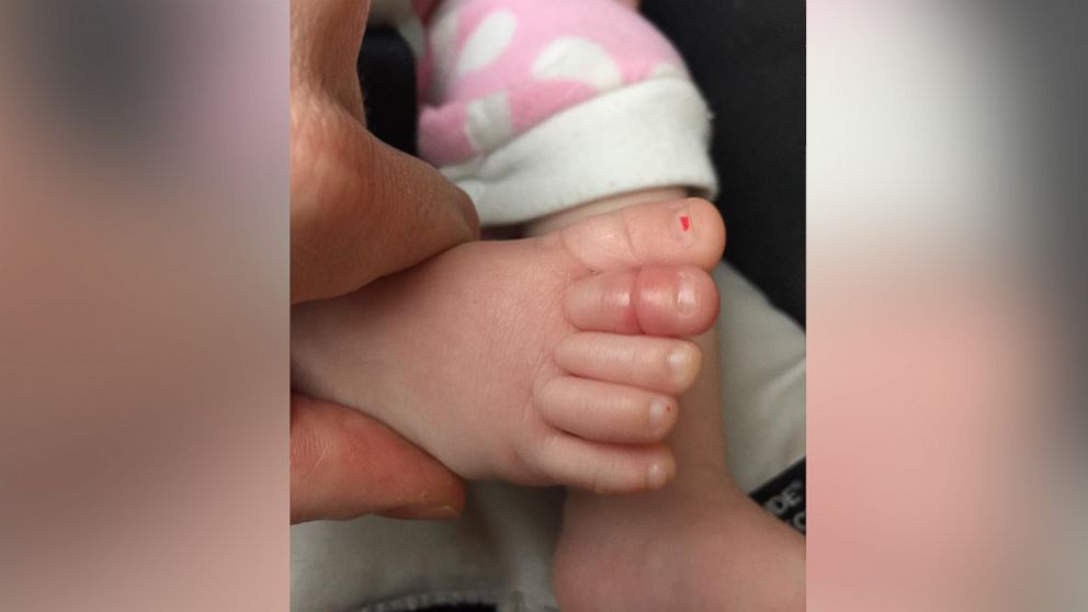 Scott Walker, 32, of Wichita, Kansas said his daughter Molly, 5 months, had a hair wrapped around her toe on Jan. 21, 2016. 