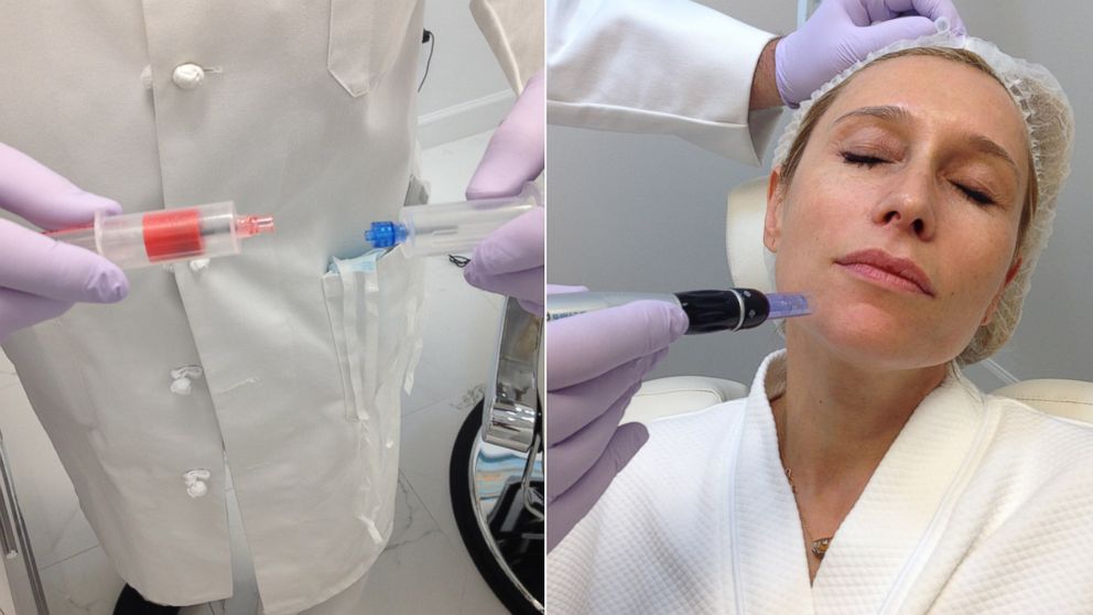 A "Blood Facial" at Esthetica MD combines the patient's centrifuged plasma with calcium chloride and then reapplies it to the face using a Dermapen to stimulate collagen production.