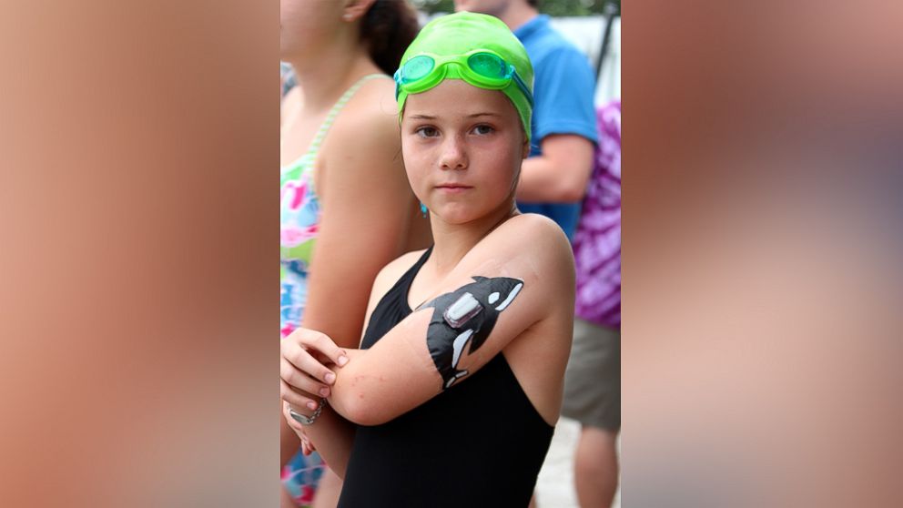 Claire Engler, 11, decorated her continuous glucose monitoring device to match the mascot for her swim team.