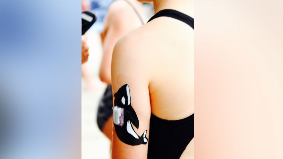 PHOTO: Claire Engler, 11, decorated her continuous glucose monitoring device to match the mascot for her swim team.