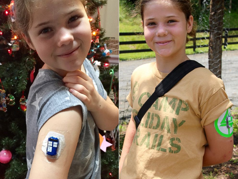 PHOTO: Claire Engler, 11, gets creative when it comes to decorating her continuous glucose monitoring device.
