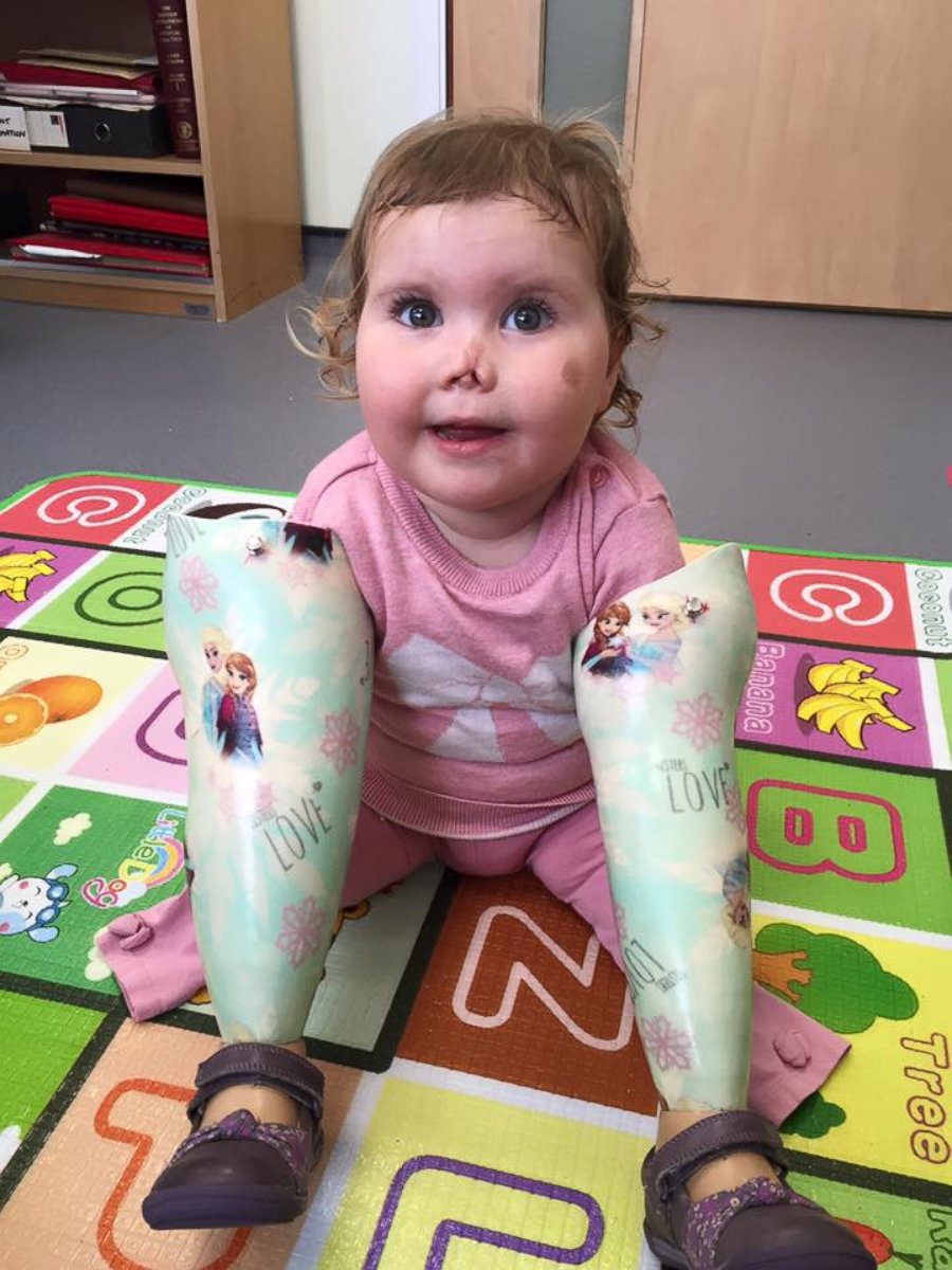 PHOTO: Harmonie-Rose Ivy Allen, 2, of Bath, England, who lost her limbs from meningitis B at 11 months old, received an American Girl doll on July 31 that "looks just like her." 