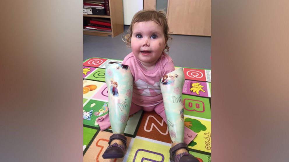 PHOTO: Harmonie-Rose Ivy Allen, 2, of Bath, England, who lost her limbs from meningitis B at 11 months old, received an American Girl doll on July 31 that "looks just like her." 