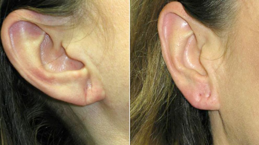 PHOTO: Women are turning to fillers like Juvederm and Restylane to plump up lobes and takes years off their ears.