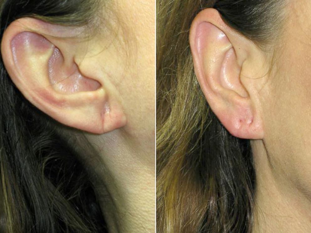 PHOTO: Women are turning to fillers like Juvederm and Restylane to plump up lobes and takes years off their ears.
