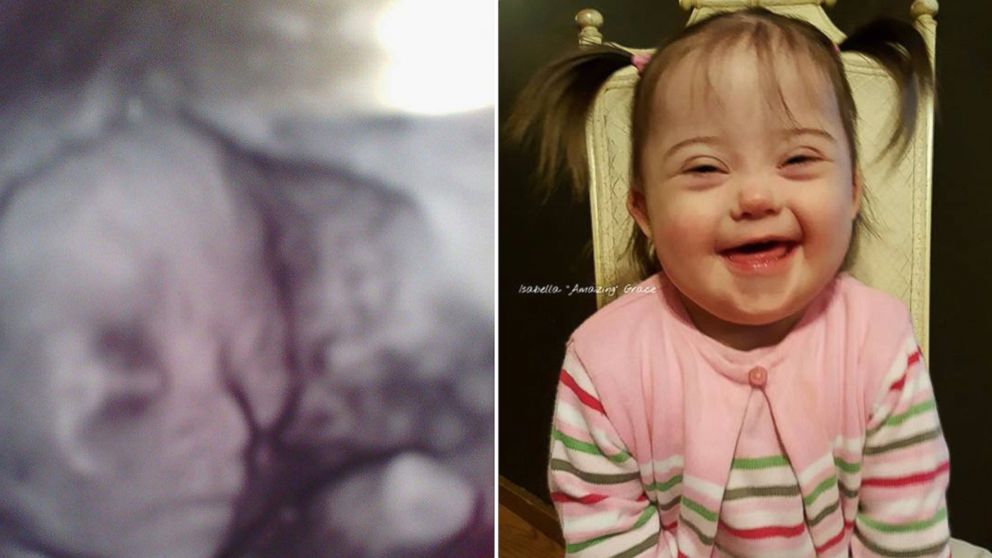 PHOTO: Cristy Proctor of Niantic, Illinois created a Facebook post on April 4 for the two-year anniversary of her daughter's Down syndrome diagnosis. 