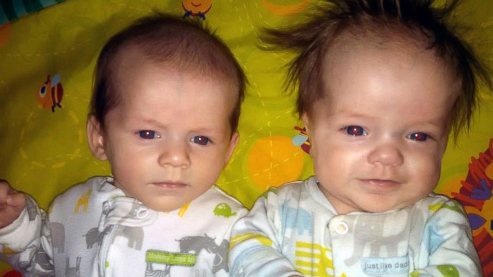 primordial dwarfism twins