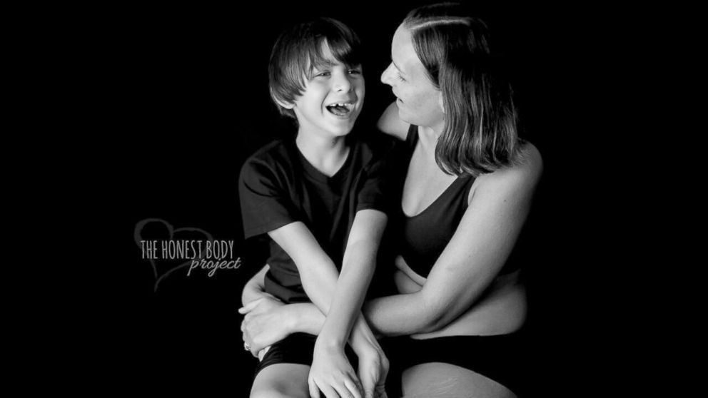 PHOTO: The "Defined by Our Hearts" photo series by The Honest Body Project celebrates the unbreakable bond between moms and their children with special needs. 
