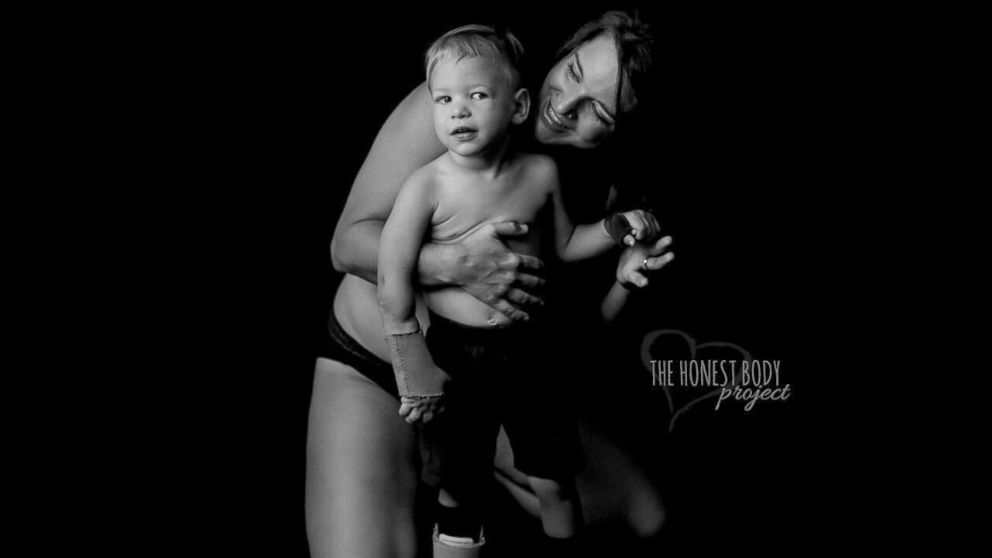 PHOTO: The "Defined by Our Hearts" photo series by The Honest Body Project celebrates the unbreakable bond between moms and their children with special needs.