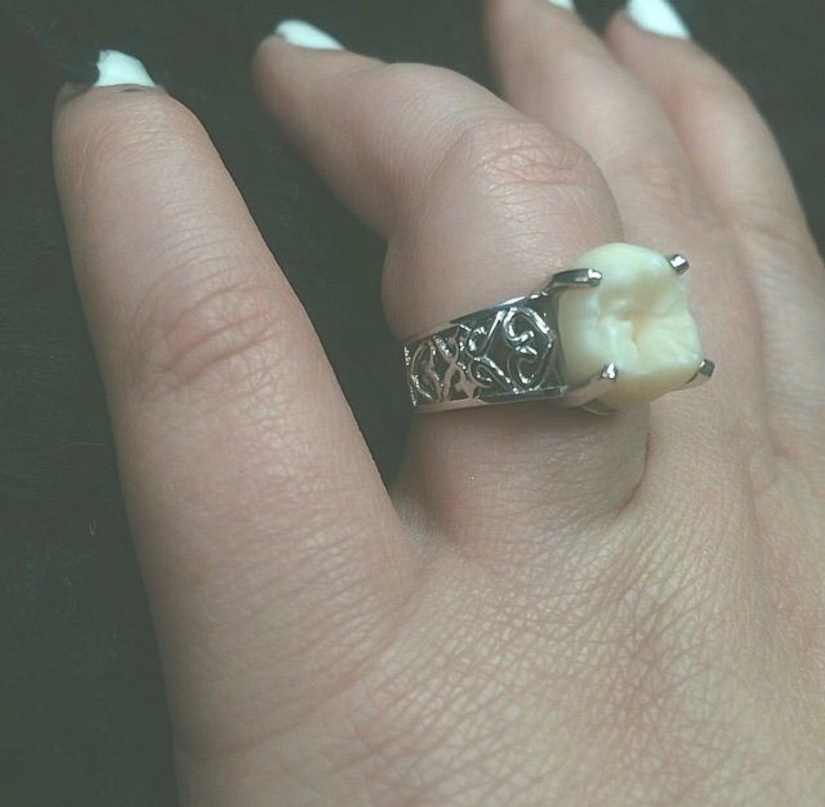 PHOTO: Carlee Leifkes' engagement ring, pictured here, is made from her fiance Lucas Unger's wisdom tooth. 