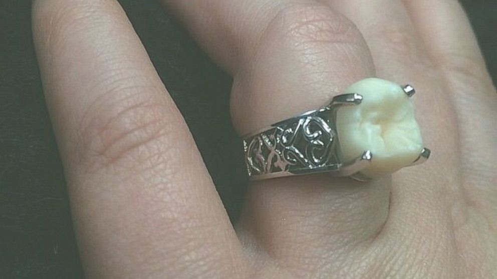 PHOTO: Carlee Leifkes' engagement ring, pictured here, is made from her fiance Lucas Unger's wisdom tooth. 
