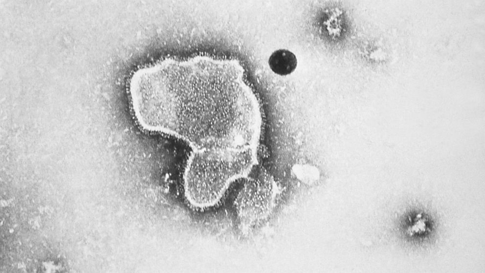 This 1981 photo provided by the Centers for Disease Control and Prevention (CDC) shows an electron micrograph of Respiratory Syncytial Virus, also known as RSV. Children's hospitals in parts of the country are seeing a distressing surge in RSV, a com
