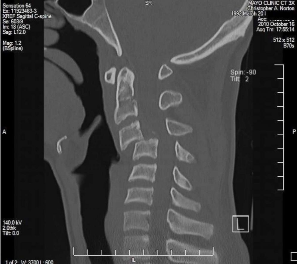 PHOTO: Chris Norton's x-ray showing his spinal chord injury.