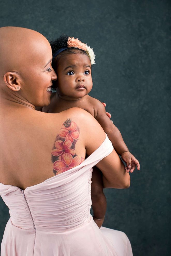 PHOTO: Courtni Guevara, who was diagnosed with alopecia last year, poses with her daughter, Zuri.